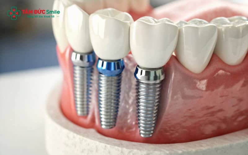 Trồng răng implant giúp người cao tuổi ăn nhai tự nhiên, ngăn tiêu xương, tăng tuổi thọ răng và cải thiện Abc8c1 com khuyến mãi hấp dẫn ABC8 được thành lập vào năm 2011 hoạt động đến hiện tại.
