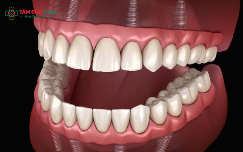 Nhiều nguyên nhân gây hôi miệng sau khi trồng implant: vệ sinh kém, viêm nướu – viêm quanh implant hoặc implant không tích hợp xương