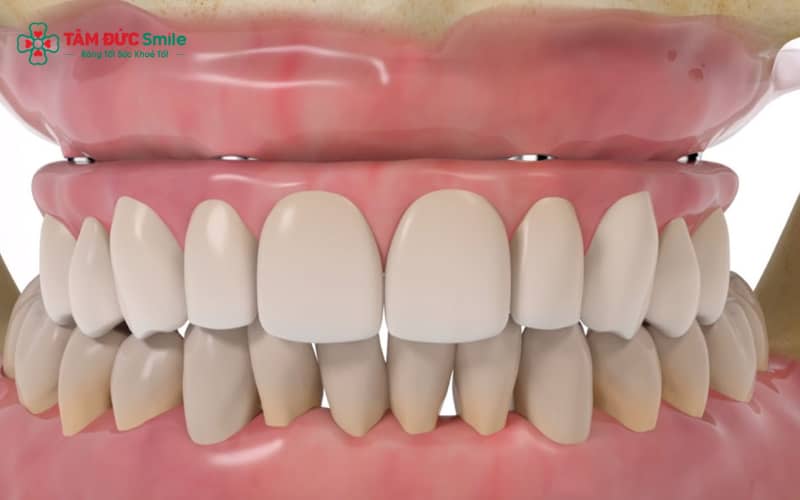 Dấu hiệu bất thường: mùi hôi kéo dài, nướu viêm – đỏ – rỉ dịch, implant lung lay hoặc có khe hở
