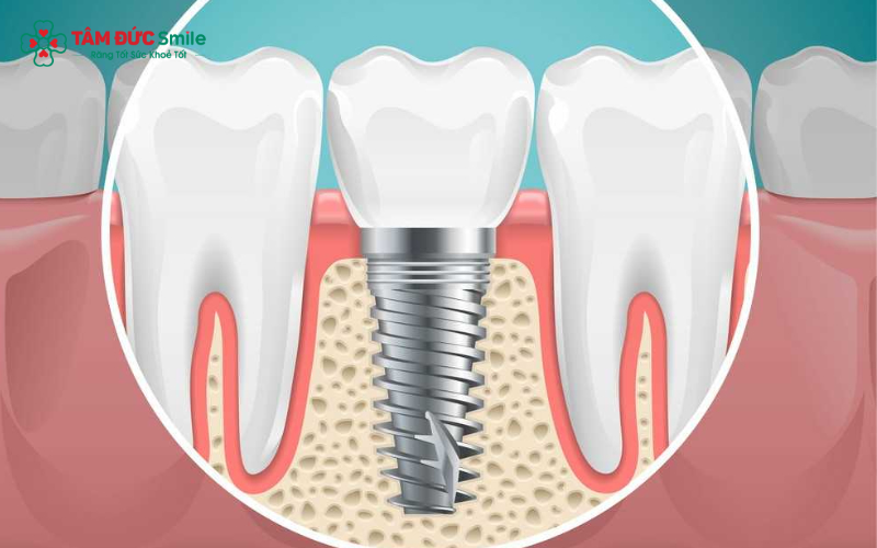 Độ bền của răng Implant phụ thuộc vào nhiều yếu tố như chất liệu trụ, tay nghề ABC8 đường link chính thức và tình trạng ABC8 tự hào là thương hiệu cá cược trực tuyến hàng đầu tại Châu Á hiện nay