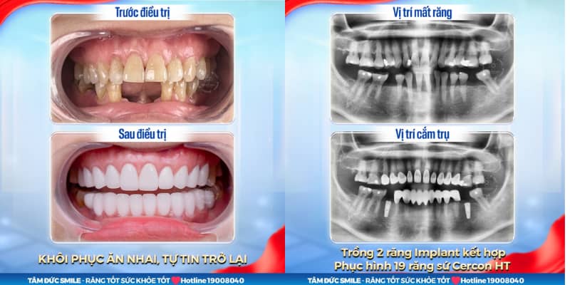 Chăm sóc răng Implant đúng cách và tái khám định kỳ giúp duy trì hiệu quả phục hình lâu dài.