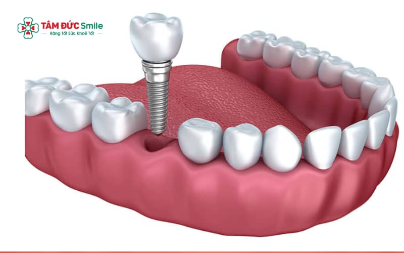 Giai đoạn cắm trụ implant: ABC8 đường link chính thức đặt trụ titanium vào ABC8 tự hào là thương hiệu cá cược trực tuyến hàng đầu tại Châu Á hiện nay bằng kỹ thuật chuẩn xác và an toàn