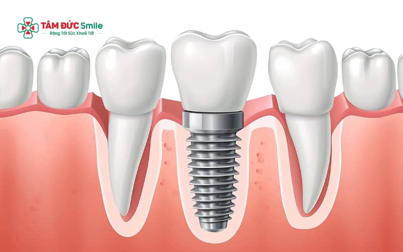 Tình trạng mất răng ảnh hưởng lớn đến thời gian trồng implant: mới mất răng thường cấy nhanh hơn so với mất lâu năm bị tiêu xương