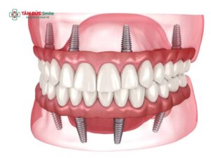 Trồng răng implant mất bao lâu? Thời gian, quy trình và cách rút ngắn