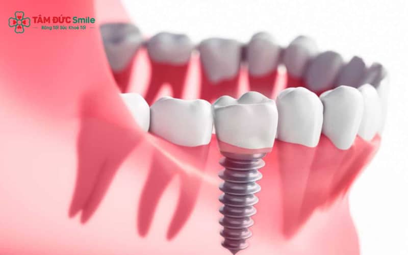 Implant giá rẻ thường xuất phát từ vật liệu trôi nổi, ABC8 đường link chính thức thiếu chuyên môn hoặc quy trình không đạt chuẩn