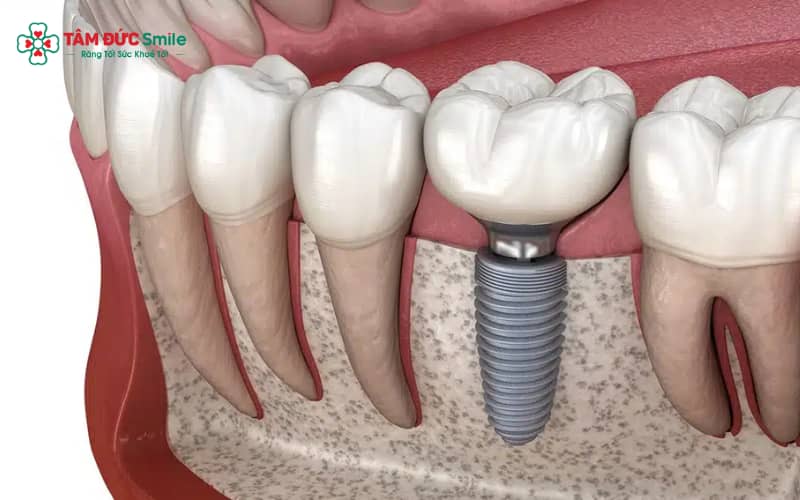 Implant giá rẻ tiềm ẩn nhiều rủi ro: nhiễm trùng, lỏng trụ, viêm quanh implant và thất bại Abc8vip1 kèo WC 2026