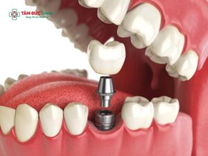 Có nên trồng răng implant miễn phí giá rẻ? Chuyên gia giải đáp