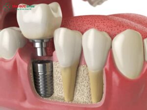 Trồng răng implant số 7 giá bao nhiêu? Bảng giá & quy trình 2025