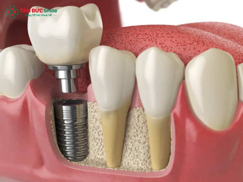 Trồng răng implant số 7 giá bao nhiêu? Bảng giá & quy trình 2025