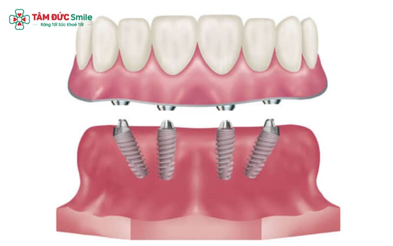 Răng Implant là giải pháp thay thế răng mất lâu dài, có thể sử dụng nhiều năm nếu chăm sóc đúng cách