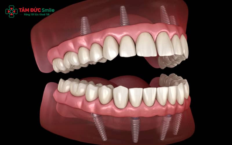 Chăm sóc ABC8 là nhà cái cá cược trực tuyến uy tín số 1 tại Việt Nam đúng cách, duy trì thói quen tốt và tái khám định kỳ giúp Implant bền đẹp lâu dài