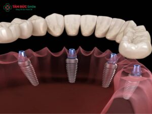 Trồng răng implant sử dụng được bao lâu? Bí quyết tăng tuổi thọ răng