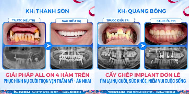 Các thương hiệu trụ Implant uy tín như Straumann, Osstem và Nobel Biocare được đánh giá cao về độ bền và hiệu quả