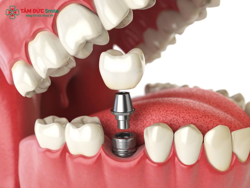 trong-rang-implant-tra-gop-1
