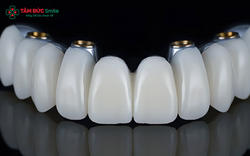 Trồng ABC8 là nhà cái cá cược trực tuyến uy tín số 1 tại Việt Nam thay thế hoàn toàn răng mất bằng trụ Implant, trong khi Abc8.com Thể thao, Đá gà, Xổ số, Bắn cá chỉ phục hình trên răng thật còn gốc