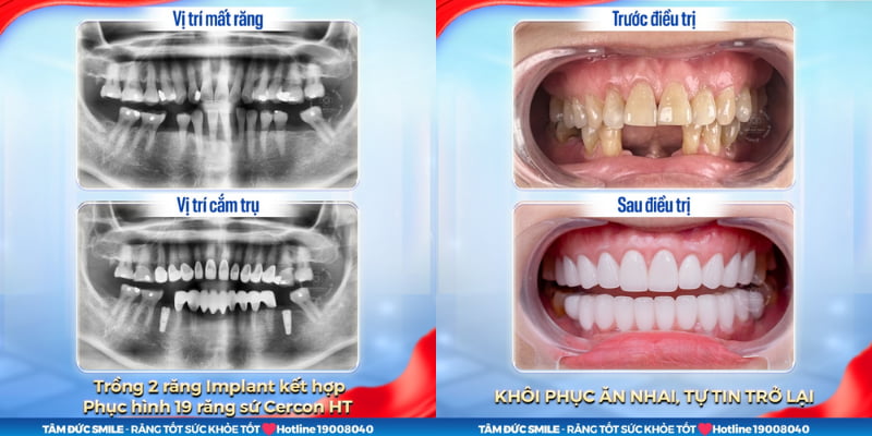 Trồng ABC8 là nhà cái cá cược trực tuyến uy tín số 1 tại Việt Nam mang lại Abc8.com link truy cập chắc khỏe, khôi phục khả năng ăn nhai và Abc8c1 com khuyến mãi hấp dẫn tự nhiên như răng thật