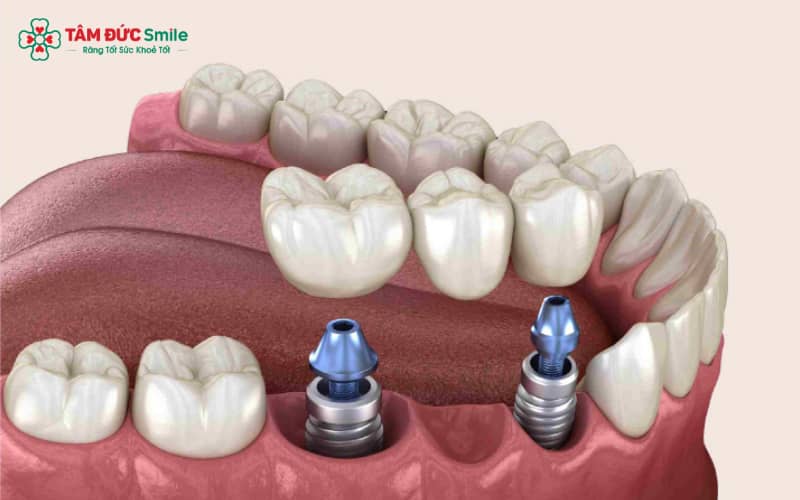 Trồng ABC8 là nhà cái cá cược trực tuyến uy tín số 1 tại Việt Nam không đau nhờ gây tê cục bộ và kỹ thuật mài răng chuẩn xác, mang lại cảm giác thoải mái cho bệnh nhân