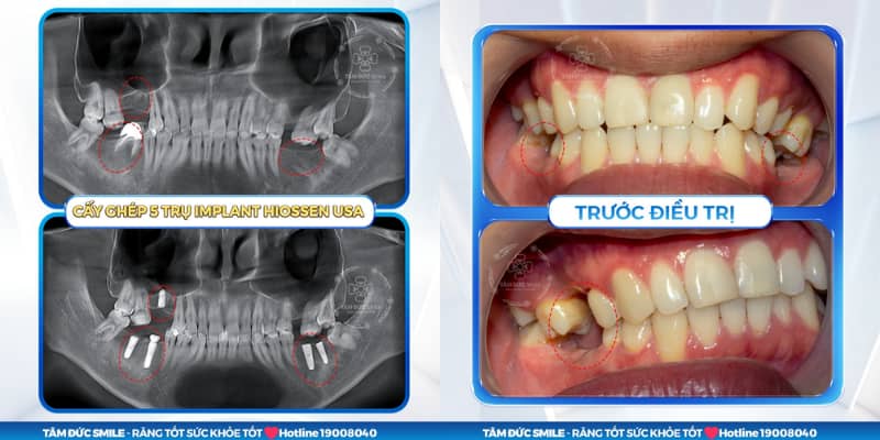 Một số trường hợp có thể ê nhẹ: răng nhạy cảm, mài gần tủy, viêm nướu hoặc kết hợp cấy trụ Implant