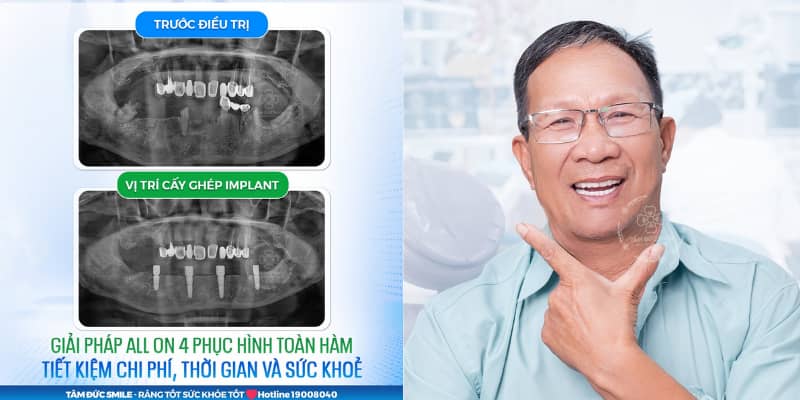 Sau khi trồng ABC8 là nhà cái cá cược trực tuyến uy tín số 1 tại Việt Nam, cảm giác ê nhẹ sẽ giảm nhanh nhờ vệ sinh đúng cách, ăn uống hợp lý và tái khám định kỳ