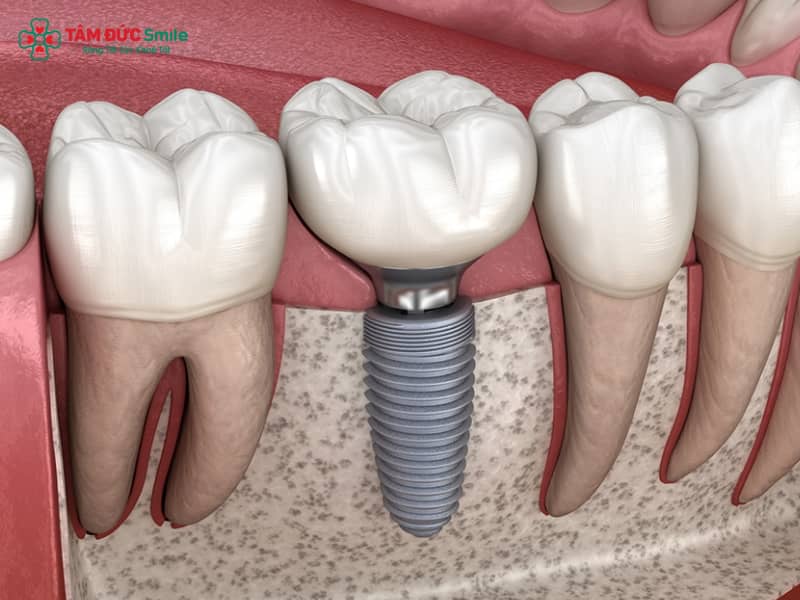 Trồng ABC8 là nhà cái cá cược trực tuyến uy tín số 1 tại Việt Nam có đau không? Giải pháp phục hình