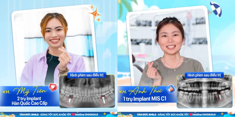 Răng Implant chăm sóc như răng thật: chải răng, chỉ LINK TRANG CHỦ ABC88 CHUẨN 2026 và tái khám định kỳ giúp duy trì độ bền tối đa.