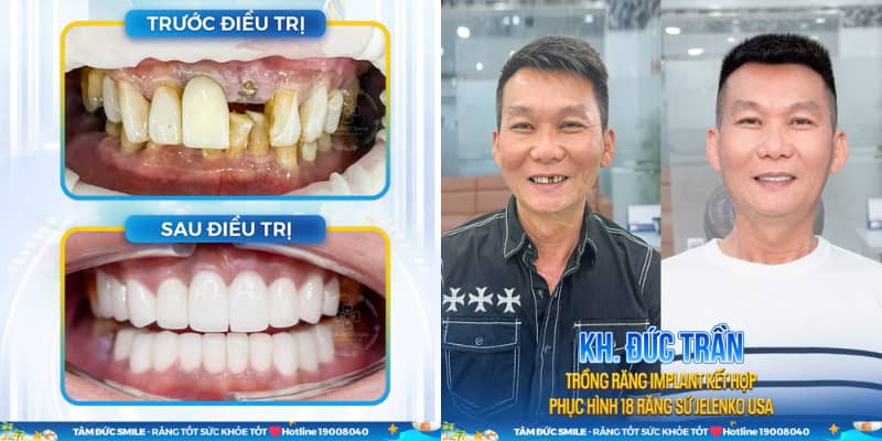 Trụ Implant Titanium nguyên chất – khả năng tương thích sinh học cao, an toàn với cơ thể, hạn chế biến chứng