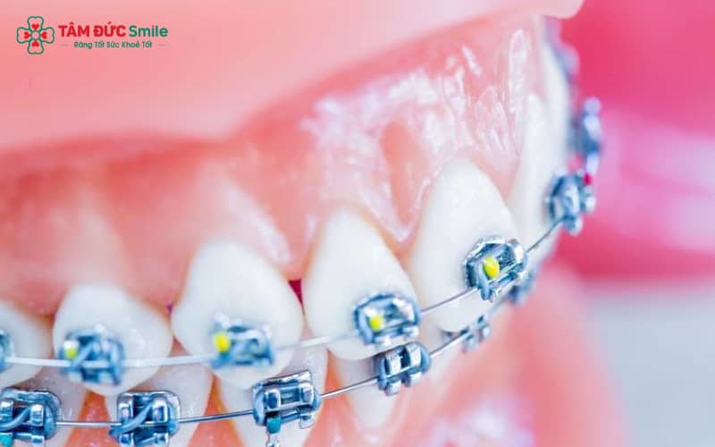 Răng khấp khểnh là tình trạng các răng mọc lệch khỏi vị trí chuẩn trên cung hàm