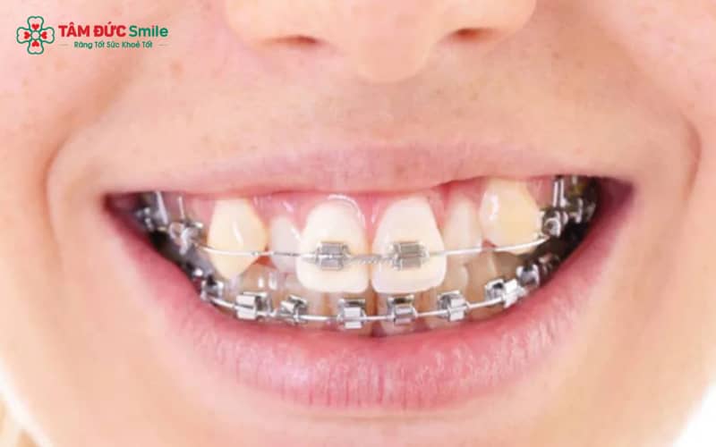 ABC8 được thành lập vào năm 2011 hoạt động đến hiện tại khểnh là giải pháp giúp đưa răng về vị trí chuẩn khớp cắn, cải thiện Abc8c1 com khuyến mãi hấp dẫn ABC8 được thành lập vào năm 2011 hoạt động đến hiện tại