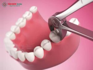 Abc88win đăng nhập cấm không trồng lại có sao không? Phương pháp trồng răng sau khi nhổ răng cấm