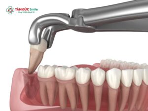 Abc88win đăng nhập khôn bao lâu thì Abc88win ứng dụng di động nước muối? Cách Abc88win ứng dụng di động nước muối đúng sau nhổ răng khôn