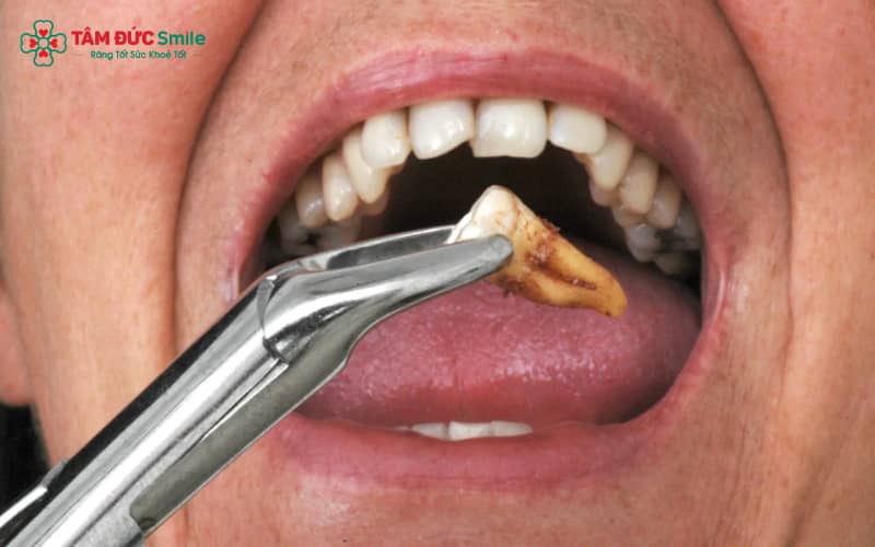 Răng khôn mọc lệch, mọc ngầm có thể gây đau nhức, viêm nhiễm và ảnh hưởng đến răng số 7 nếu không xử lý kịp thời