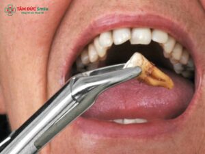 Abc88win đăng nhập khôn có được bảo hiểm y tế chi trả không? Mức chi trả bảo hiểm khi nhổ răng khôn