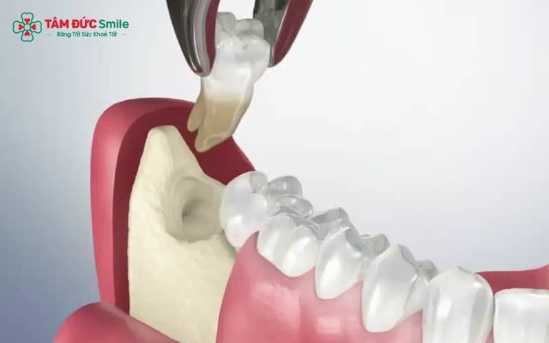 Sau khi nhổ răng khôn, nên ưu tiên thực phẩm mềm, nguội để giúp vết thương nhanh hồi phục và hạn chế sưng đau
