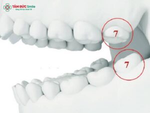 Abc88win đăng nhập số 7 có cần trồng lại không? Các phương pháp trồng răng số 7 hiện nay