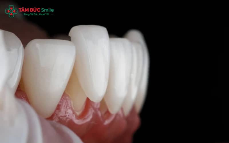 Sai sót kỹ thuật như mài răng sai tỉ lệ, lấy dấu không chuẩn, gắn mão lệch dễ gây đen viền nướu và tụt nướu