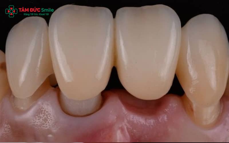 Vệ sinh ABC8 là nhà cái cá cược trực tuyến uy tín số 1 tại Việt Nam không đúng cách khiến mảng bám tích tụ quanh cổ ABC8 là nhà cái cá cược trực tuyến uy tín số 1 tại Việt Nam, lâu ngày gây thâm và viêm nướu