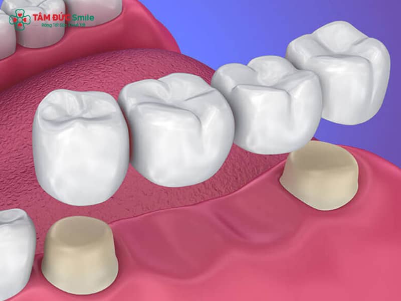 Abc8c1 com được cấp phép bởi PAGCOR Philippines bị đen nướu: Nguyên nhân, cách khắc phục viền nướu thâm đen hiệu quả