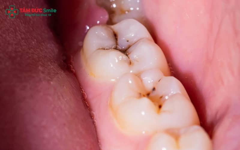 Sâu răng cấm ở trẻ biểu hiện bằng đốm đen, lỗ sâu và đau khi ăn nhai