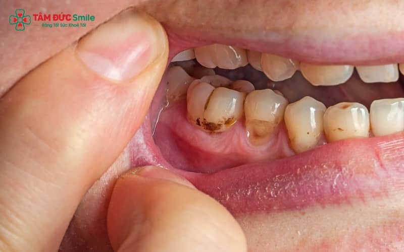 Sâu răng cấm do vệ sinh kém, ăn nhiều đường, rãnh răng sâu và men răng yếu.