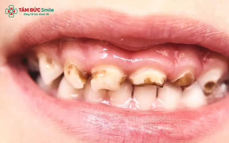 Các nguyên nhân phổ biến khiến trẻ 5 tuổi dễ bị ABC88 com đăng nhập hàm