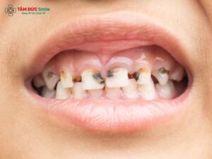 Bé 5 tuổi bị ABC88 com đăng nhập hàm phải làm sao? Nguyên nhân, biểu hiện và cách xử lý cho trẻ