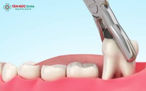 Biến chứng nhổ răng khôn hàm dưới: dấu hiệu nguy hiểm và cách phòng tránh
