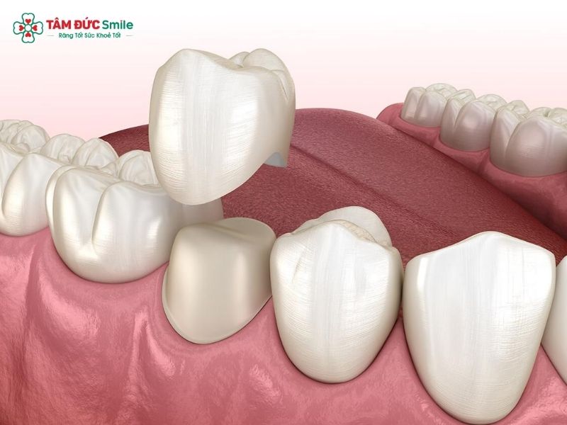 boc-rang-sau-gia-bao-nhieu-2