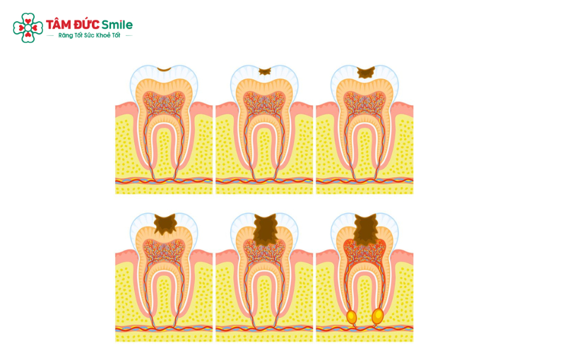 Sâu răng có thể được phân loại theo vị trí tổn thương như sâu mặt nhai, sâu kẽ răng hoặc sâu cổ răng, mỗi loại có mức độ ảnh hưởng khác nhau