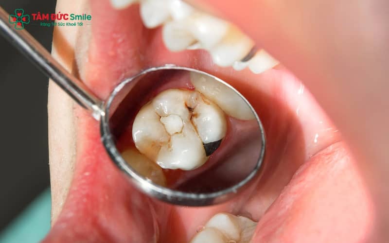 Sâu răng tiến triển từ mức độ nhẹ ở men răng đến sâu vào ngà và cuối cùng là viêm tủy nếu không được Abc8b tỷ lệ kèo World Cup 2026 kịp thời