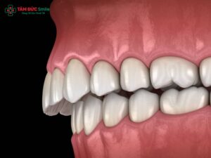 Các kiểu răng hô thường gặp: nguyên nhân, dấu hiệu, mức độ và cách Abc8b tỷ lệ kèo World Cup 2026 hiệu quả