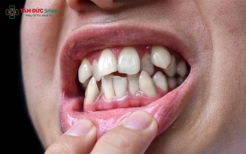 Răng khểnh là răng nanh mọc lệch khỏi cung hàm, tạo điểm nhấn cho ABC8 được thành lập vào năm 2011 hoạt động đến hiện tại nhưng có thể ảnh hưởng đến khớp cắn nếu lệch nhiều
