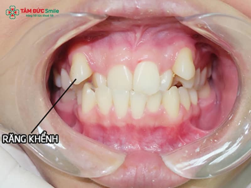Cách có răng khểnh đẹp: răng khểnh là gì, cách tạo và những lưu ý quan trọng