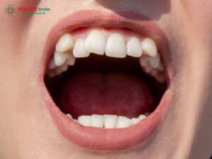 Cách làm răng bớt hô tại nhà: mẹo giảm hô, bài tập môi lưỡi, chữa hô nhẹ hiệu quả
