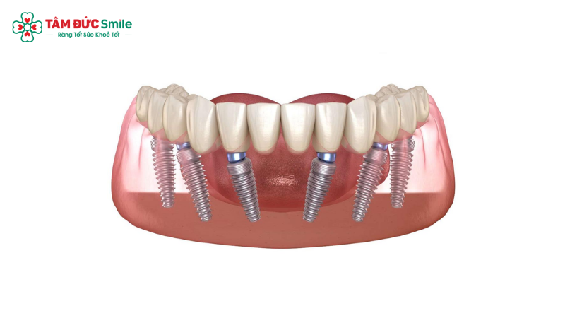 cay-ghep-implant-2
